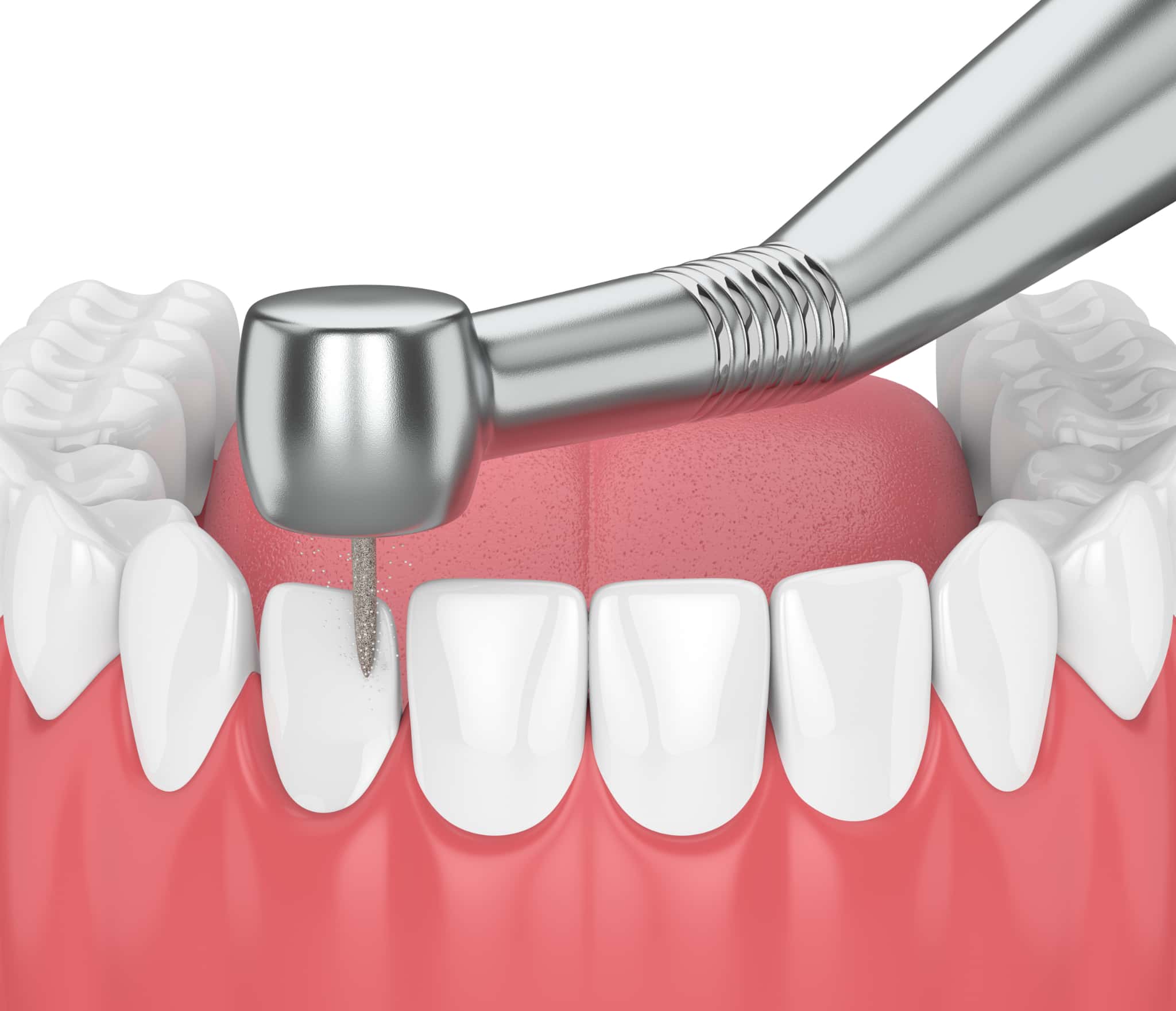 矯正のために歯科器具のバーで歯を削っているイメージ