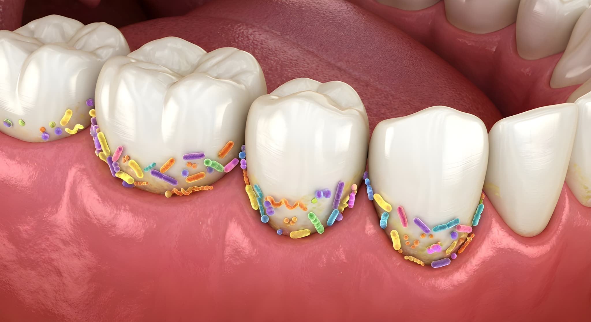 虫歯の原因となるミュータンス菌のイメージ