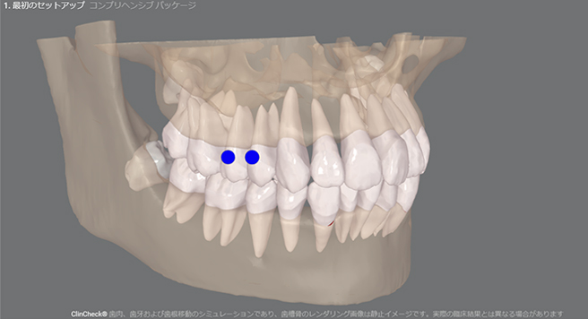 「Nemo」でより精度の高い矯正治療を実現