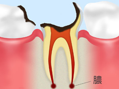 C4：歯根にまで達した虫歯