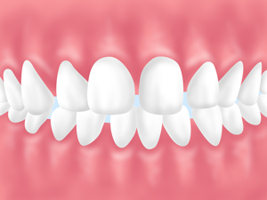 上下の歯列の中央にすき間がある
