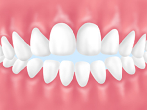 前歯が咬み合わず開いている