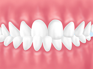 下の歯列上の歯列よりが前に出ている