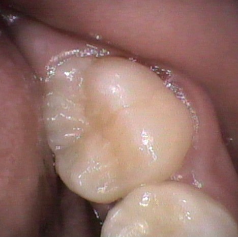 小児の虫歯予防に