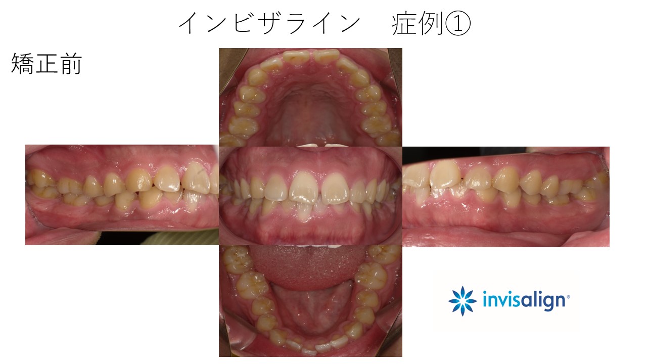 インビザライン　症例