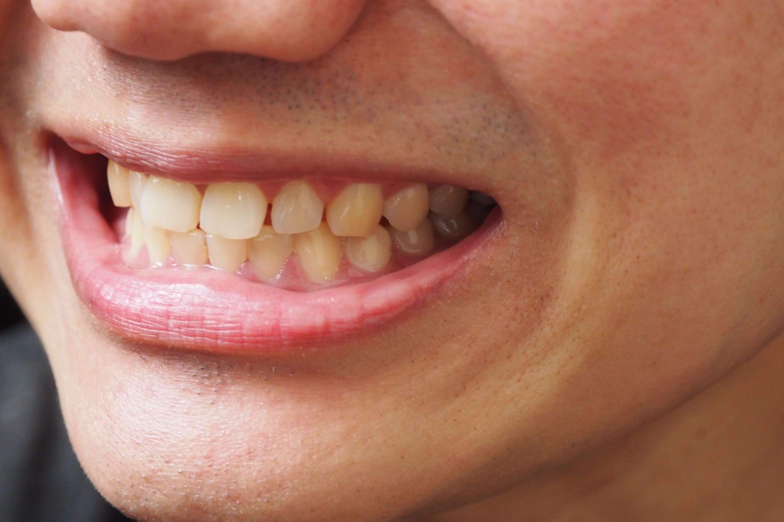 すきっ歯（空隙歯列）の歯並び